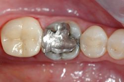 herder experimenteel Chirurgie Esthetische tandheelkunde: gouden vs porseleinen kroon | Nederlands  Tandarts Instituut