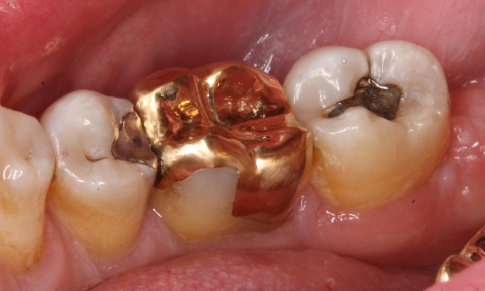 herder experimenteel Chirurgie Esthetische tandheelkunde: gouden vs porseleinen kroon | Nederlands  Tandarts Instituut